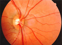 Ph.1 : nerf optique normal